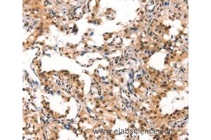 Immunohistochemistry of Human gastric cancer using CUL4B Polyclonal Antibody at dilution of 1:50 (Cullin 4B anticorps)