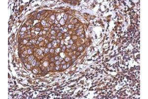 IHC-P Image Immunohistochemical analysis of paraffin-embedded human breast cancer, using TRIM25, antibody at 1:500 dilution. (TRIM25 anticorps)