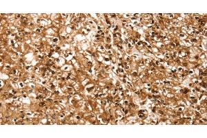 Immunohistochemistry of paraffin-embedded Human prostate cancer using RBM5 Polyclonal Antibody at dilution of 1:30 (RBM5 anticorps)