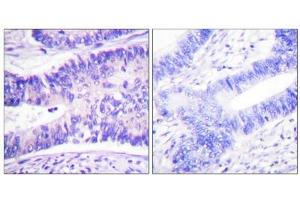 Immunohistochemistry analysis of paraffin-embedded human colon carcinoma tissue using WAVE1 (Phospho-Tyr125) antibody.