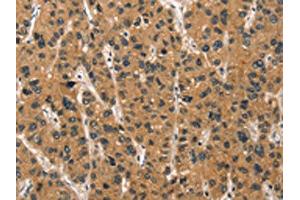 The image on the left is immunohistochemistry of paraffin-embedded Human liver cancer tissue using ABIN7190457(DEFA1/3 Antibody) at dilution 1/30, on the right is treated with synthetic peptide. (DEFA1/DEFA3 anticorps)
