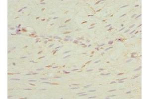 Immunohistochemistry of paraffin-embedded human colon cancer using ABIN7169101 at dilution of 1:100