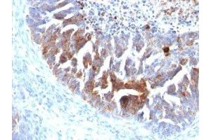 Formalin-fixed, paraffin-embedded human ovarian carcinoma stained with TAG-72 antibody (B72. (TAG-72 anticorps)