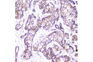 IHC testing of FFPE human breast cancer with Beta Catenin antibody.
