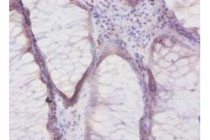 Immunohistochemistry of paraffin-embedded human colon cancer using ABIN7145472 at dilution of 1:50 (beta Defensin 1 anticorps  (AA 33-68))