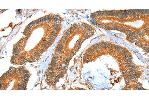 Immunohistochemistry of paraffin-embedded Human colon cancer using ACOT11 Polyclonal Antibody at dilution of 1:40
