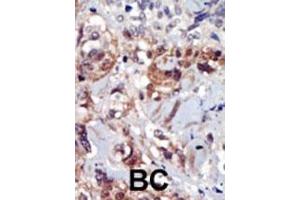 Formalin-fixed and paraffin-embedded human cancer tissue reacted with the primary antibody, which was peroxidase-conjugated to the secondary antibody, followed by AEC staining.