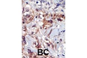 Formalin-fixed and paraffin-embedded human cancer tissue reacted with the primary antibody, which was peroxidase-conjugated to the secondary antibody, followed by AEC staining. (PIP4K2A anticorps  (C-Term))