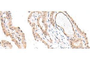 Immunohistochemistry of paraffin-embedded Human thyroid cancer tissue using FANCE Polyclonal Antibody at dilution of 1:50(x200)