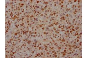 IHC image of ABIN7127503 diluted at 1:100 and staining in paraffin-embedded human glioma cancer performed on a Leica BondTM system.