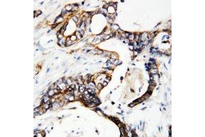Anti-uPA Receptor antibody, IHC(P) IHC(P): Human Mammary Cancer Tissue (PLAUR anticorps  (C-Term))