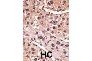 Formalin-fixed and paraffin-embedded human hepatocellular carcinoma tissue reacted with MAGEA12 polyclonal antibody  , which was peroxidase-conjugated to the secondary antibody, followed by AEC staining. (MAGEA12 anticorps  (N-Term))
