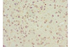 Immunohistochemistry of paraffin-embedded human glioma using ABIN7143513 at dilution of 1:100