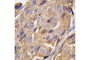 IHC analysis of FFPE human breast carcinoma tissue stained with EIF4B antibody