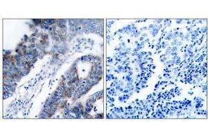 Immunohistochemical analysis of paraffin- embedded human breast carcinoma tissue, using ASK1 (Ab-83) antibody (E021125). (ASK1 anticorps)