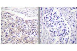 Immunohistochemical analysis of paraffin-embedded human breast carcinoma tissue using p90 RSK (Phospho-Thr573) antibody (left)or the same antibody preincubated with blocking peptide (right).