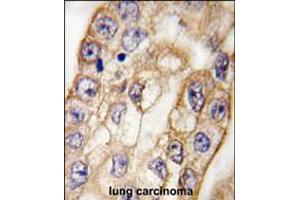 Formalin-fixed and paraffin-embedded human lung carcinoma tissue reacted with CD8A antibody , which was peroxidase-conjugated to the secondary antibody, followed by DAB staining.