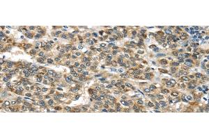 Immunohistochemistry of paraffin-embedded Human liver cancer tissue using TNFAIP2 Polyclonal Antibody at dilution 1:40 (TNFAIP2 anticorps)
