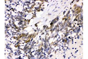 Anti- Cdk4 Picoband antibody, IHC(P) IHC(P): Human Lung Cancer Tissue (CDK4 anticorps  (AA 201-303))