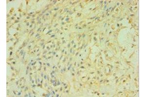 Immunohistochemistry of paraffin-embedded human breast cancer using ABIN7146501 at dilution of 1:100 (CALML5 anticorps  (AA 1-146))