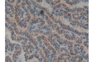 DAB staining on IHC-P; Samples: Human Thyroid cancer Tissue