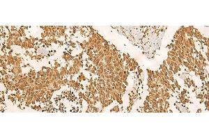 Immunohistochemistry of paraffin-embedded Human lung cancer tissue using EFTUD2 Polyclonal Antibody at dilution of 1:45(x200) (EFTUD2 anticorps)