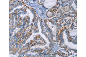 Immunohistochemistry of Human thyroid cancer using GPA33 Polyclonal Antibody at dilution of 1:30 (GPA33 anticorps)