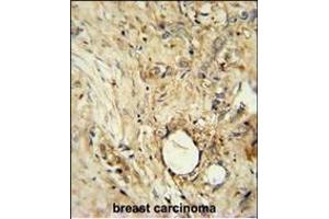 ITIH5 Antibody (C-term) (ABIN654918 and ABIN2844563) immunohistochemistry analysis in formalin fixed and paraffin embedded human breast carcinoma followed by peroxidase conjugation of the secondary antibody and DAB staining. (ITIH5 anticorps  (C-Term))
