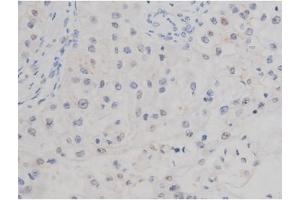 ABIN6267362 at 1/200 staining Human kidney cancer tissue sections by IHC-P.