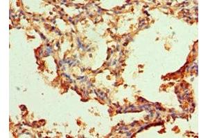 Immunohistochemistry of paraffin-embedded human lung tissue using ABIN7143754 at dilution of 1:100 (SERPINA3 anticorps  (AA 24-423))