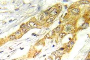 Immunohistochemistry (IHC) analyzes of ERK1/2 antibody in paraffin-embedded human breast carcinoma tissue. (ERK1/2 anticorps)
