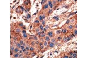 IHC analysis of FFPE human breast carcinoma tissue stained with the ALK3 antibody