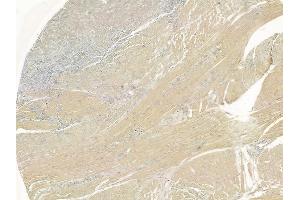 ABIN6266234 and ABIN6277388 at 1/100 staining human tongue carcinoma by IHC-P. (IGFBP7 anticorps  (Internal Region))