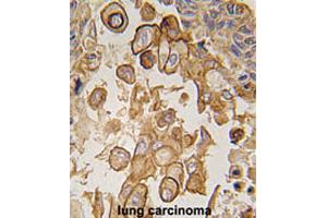 Formalin-fixed and paraffin-embedded human lung carcinomareacted with Tlr6 polyclonal antibody , which was peroxidase-conjugated to the secondary antibody, followed by AEC staining. (TLR6 anticorps  (C-Term))