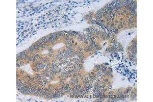 Immunohistochemistry of Human colon cancer using MT2A Polyclonal Antibody at dilution of 1:40 (MT2A anticorps)