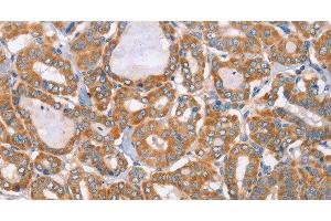 Immunohistochemistry of paraffin-embedded Human thyroid cancer tissue using MTMR7 Polyclonal Antibody at dilution 1:40 (MTMR7 anticorps)