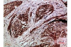 Immunohistochemical analysis of paraffin-embedded human-cervical-cancer, antibody was diluted at 1:200