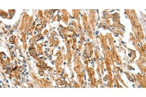 Immunohistochemistry of paraffin-embedded Human gastric cancer tissue using TGF β Receptor I Polyclonal Antibody at dilution 1:60 (TGFBR1 anticorps)