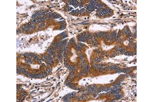 Immunohistochemical analysis of paraffin-embedded Human colon cancer tissue using at dilution 1/30. (KIR2DL3 anticorps  (Internal Region))