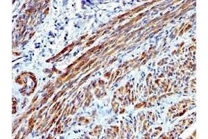 Formalin-fixed, paraffin-embedded human Leiomyosarcoma stained with SMMHC antibody (MYH11/923). (MYH11 anticorps)