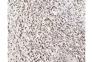 Immunohistochemistry analysis of paraffin-embedded human lung cancer using c-Fos Polyclonal Antibody at dilution of 1:200. (c-FOS anticorps)