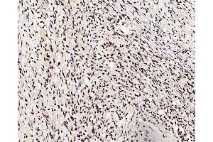 Immunohistochemistry analysis of paraffin-embedded human lung cancer using c-Fos Polyclonal Antibody at dilution of 1:200.