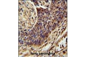 ZSWIM1 Antibody (C-term) (ABIN654558 and ABIN2844265) immunohistochemistry analysis in formalin fixed and paraffin embedded human lung carcinoma followed by peroxidase conjugation of the secondary antibody and DAB staining. (ZSWIM1 anticorps  (C-Term))