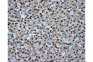 Immunohistochemical staining of paraffin-embedded Adenocarcinoma of colon tissue using anti-APP mouse monoclonal antibody. (APP anticorps)