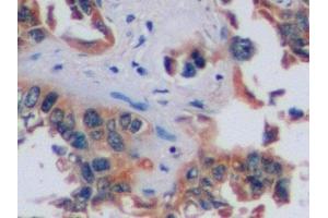 Detection of CA9 in Human Lung cancer Tissue using Polyclonal Antibody to Carbonic Anhydrase IX (CA9)