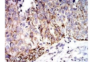 Immunohistochemical analysis of paraffin-embedded ovarian cancer tissues using SOD2 mouse mAb with DAB staining.