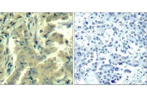 Immunohistochemical analysis of paraffin-embedded human lung carcinoma tissue using PLC-γ2 (Ab-1217) Antibody (E021524).