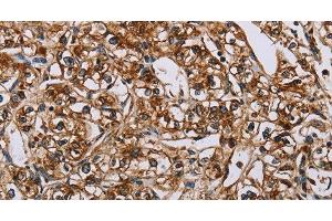 Immunohistochemistry of paraffin-embedded Human prostate cancer using BMP6 Polyclonal Antibody at dilution of 1:50 (BMP6 anticorps)
