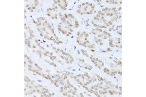 Immunohistochemistry of paraffin-embedded human colon carcinoma using SIRT1 antibody (ABIN6291361) at dilution of 1:100 (40x lens). (SIRT1 anticorps)