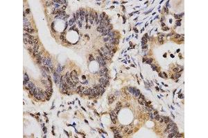 Immunohistochemistry of paraffin-embedded Human rectal cancer using DiMethyl-Histone H3-K14 Polyclonal Antibody at dilution of 1:200 (40x lens).